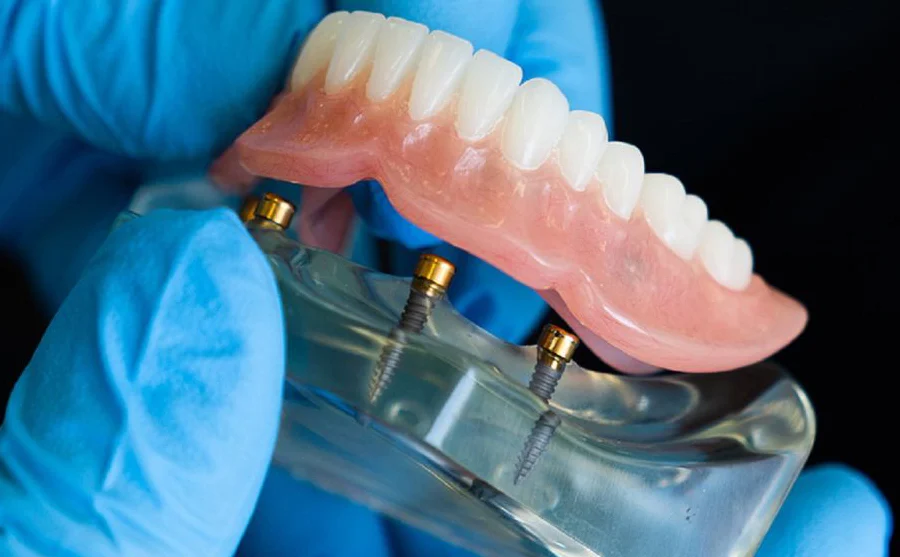Implant Supported Dentures Model