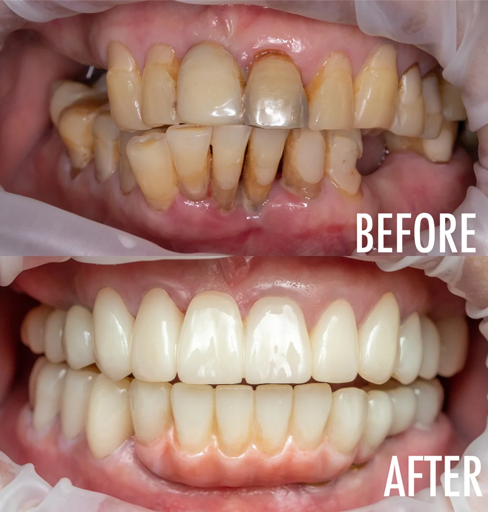 Dental Implant Patient before & After Smile