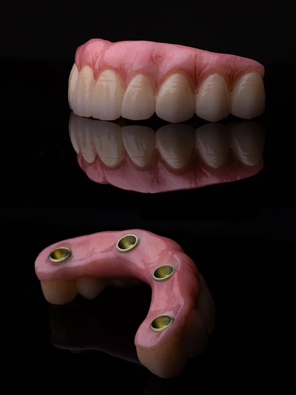 Dr. Tan Khuu Full Arch Dental Implant Case