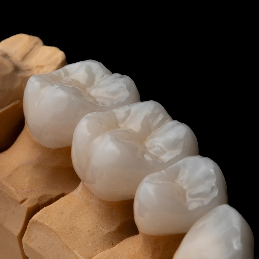 Garden Grove Dental Crowns Case By Tan Khuu DDS